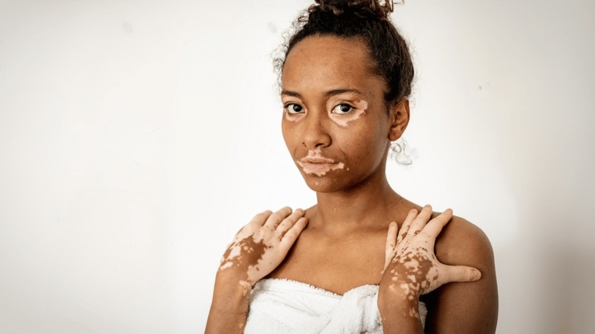 Vitiligo On Lips How To Treat White
