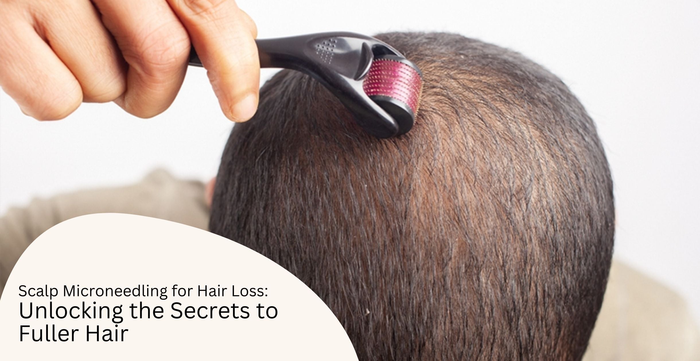 Scalp Microneedling for Hair Loss: Unlocking the Secrets to Fuller Hair