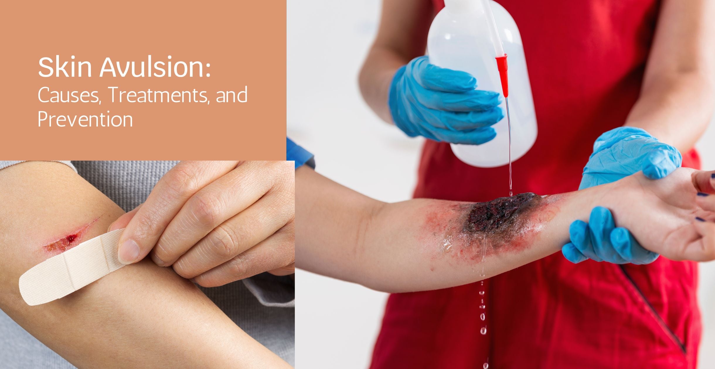 Skin Avulsion: Causes, Treatments, and Prevention