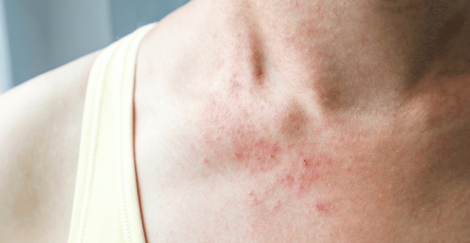 What can trigger hives rash?