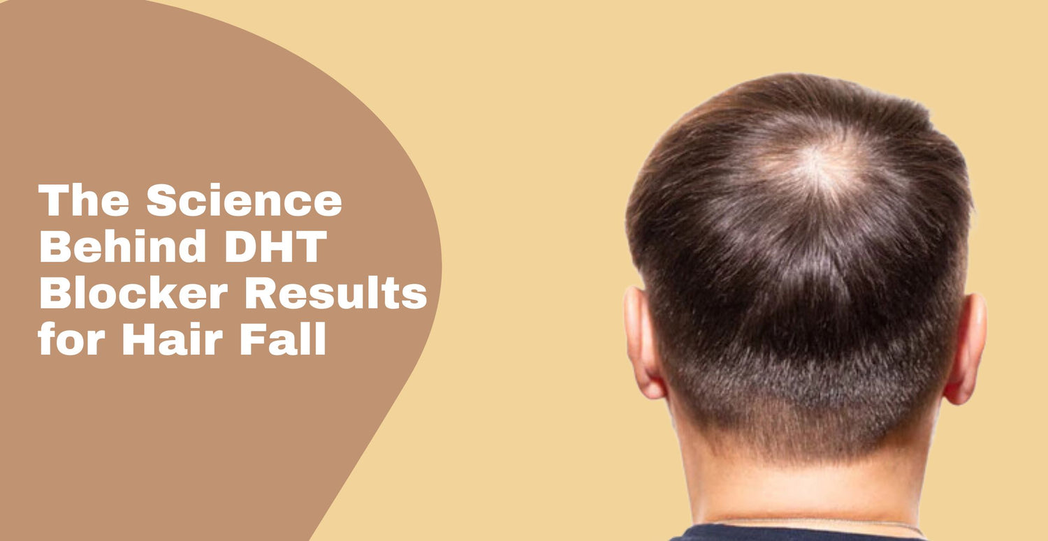 DHT hair loss