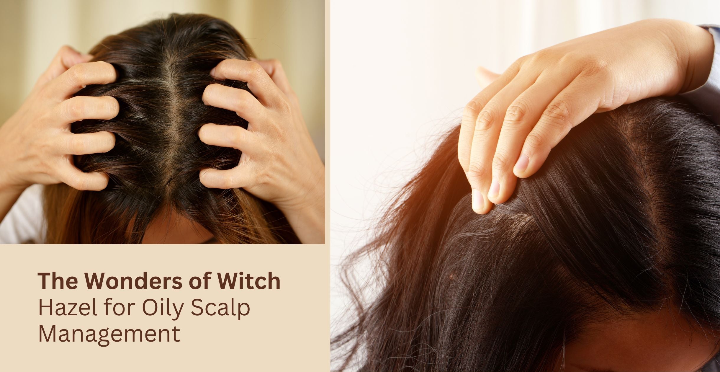 The Wonders of Witch Hazel for Oily Scalp Management