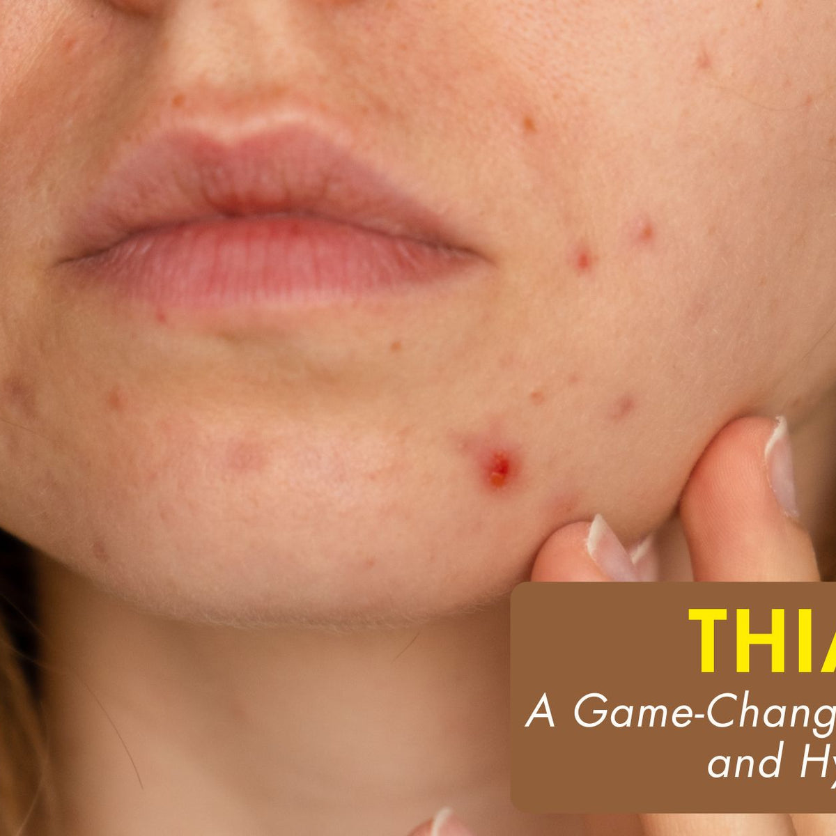 thiamidol vs glutathione Buy Thiamidol For Melasma Pigmentation: Dermatologist Review main image 0
