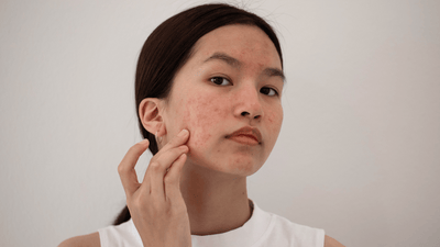 Chocolate and Breakouts: Fact or Fiction?