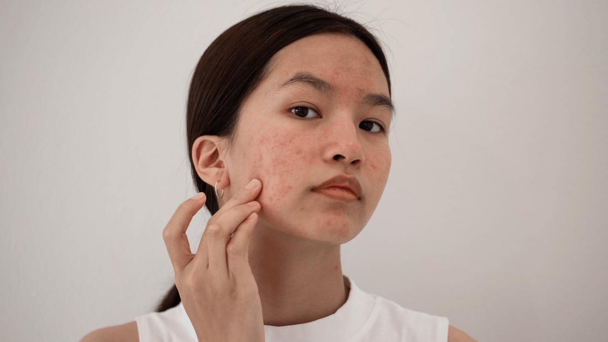 Does chocolate cause acne 