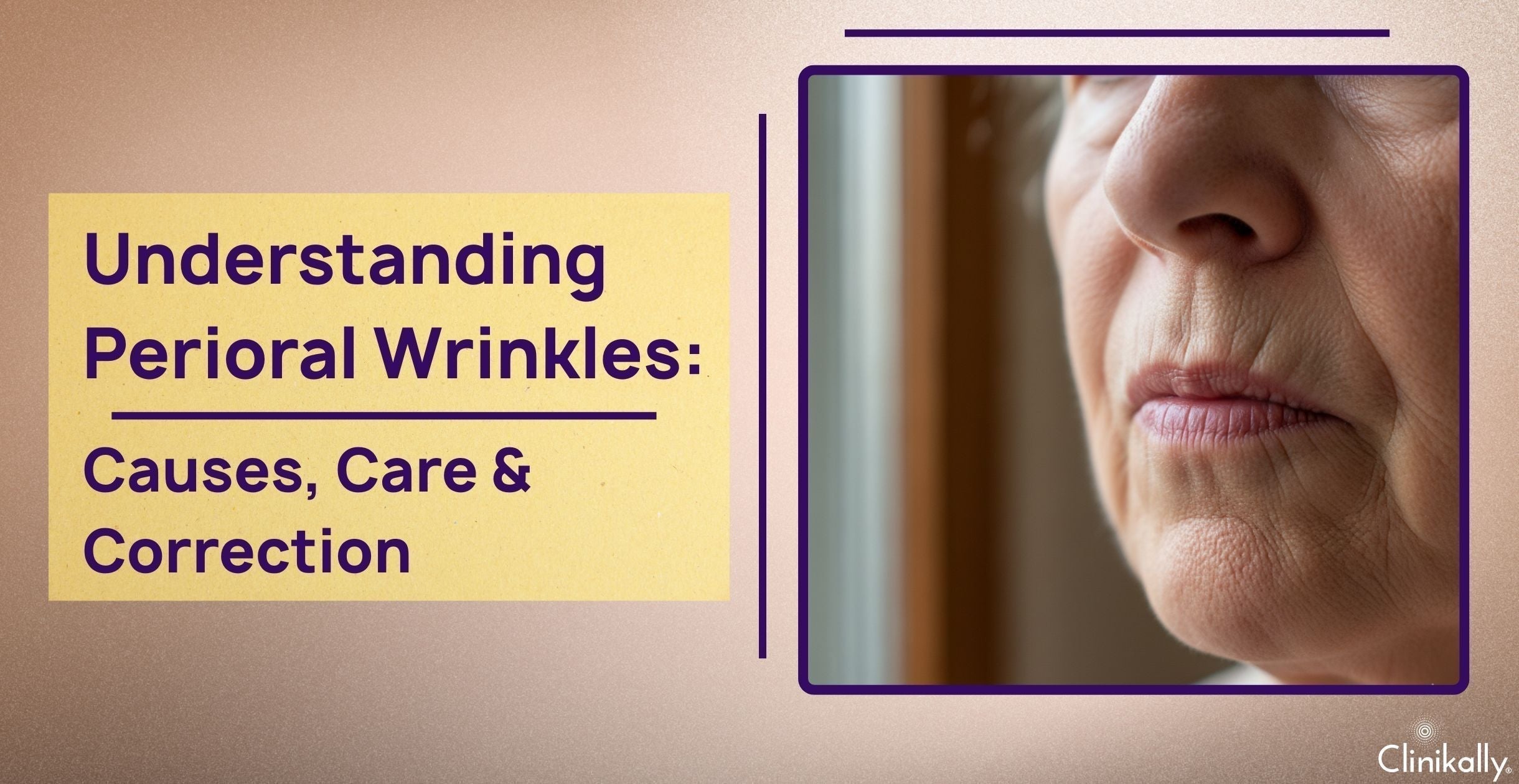 Understanding Perioral Wrinkles: Causes, Care & Correction
