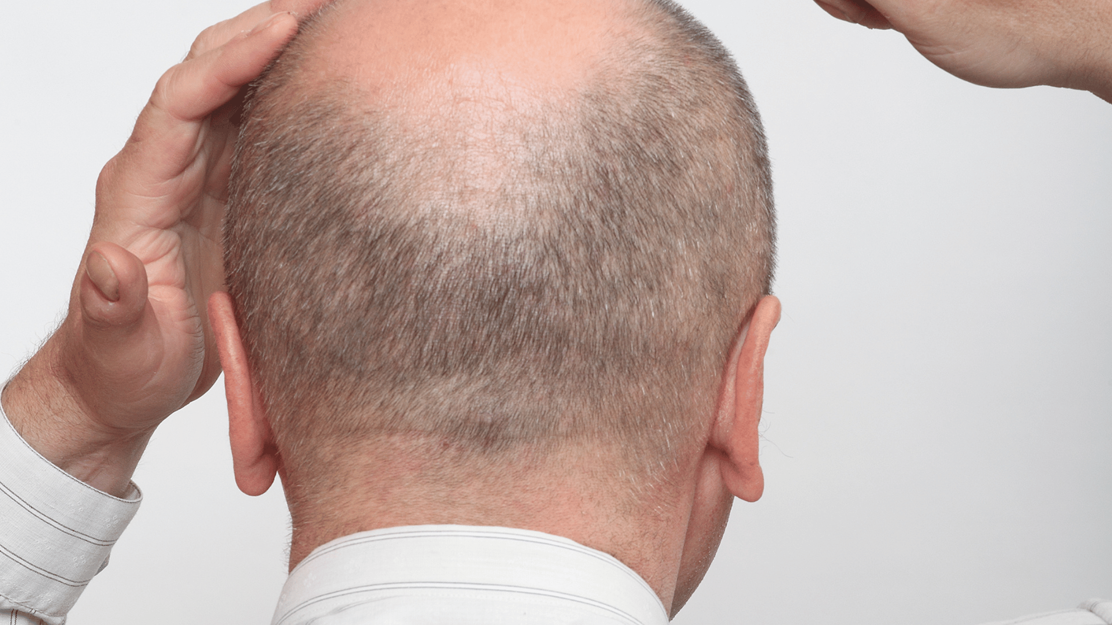 The Bald and the Beautiful: Haircuts for Balding Men