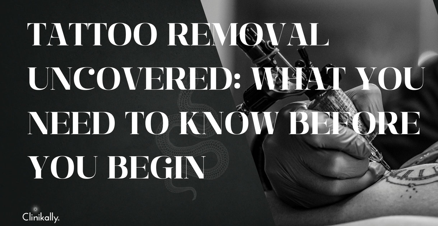 Tattoo Removal Uncovered: What You Need to Know Before You Begin