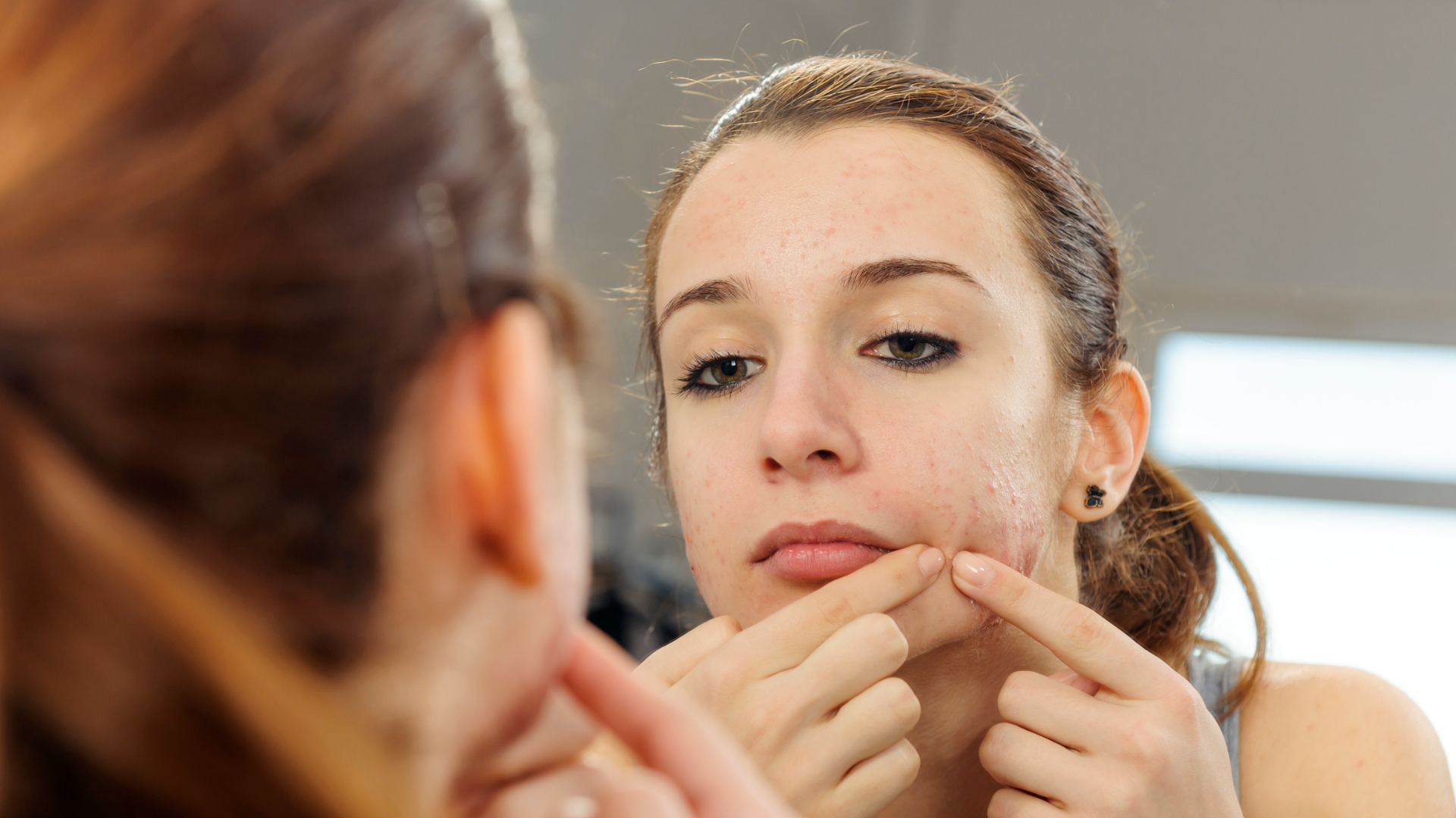 post acne treatment