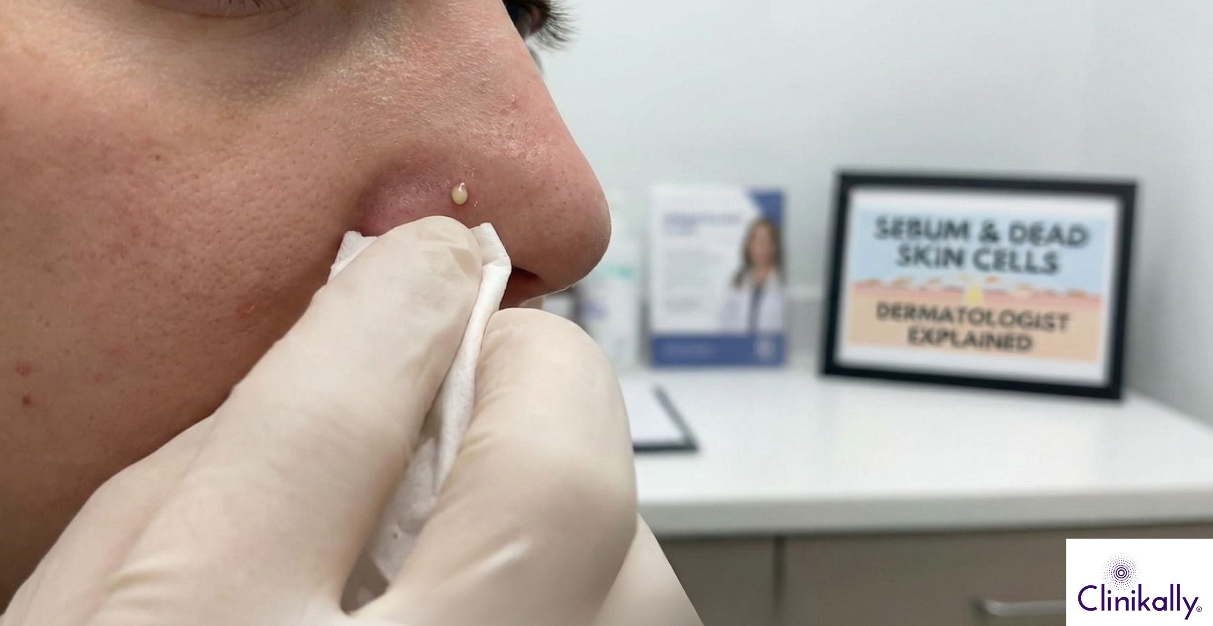 What Is the White Stuff in Your Nose Pores? Skin Experts Explain