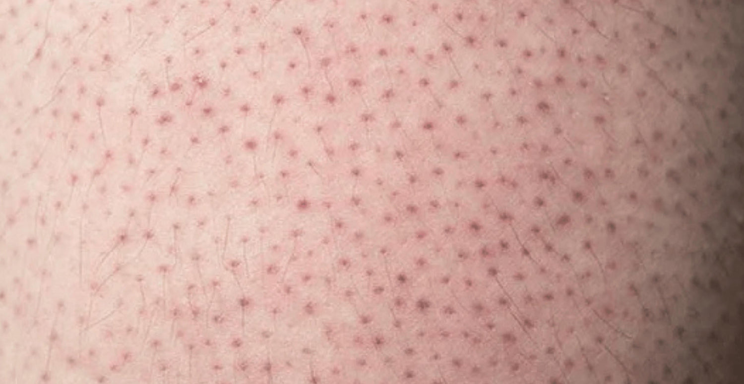 keratosis pilaris treatment