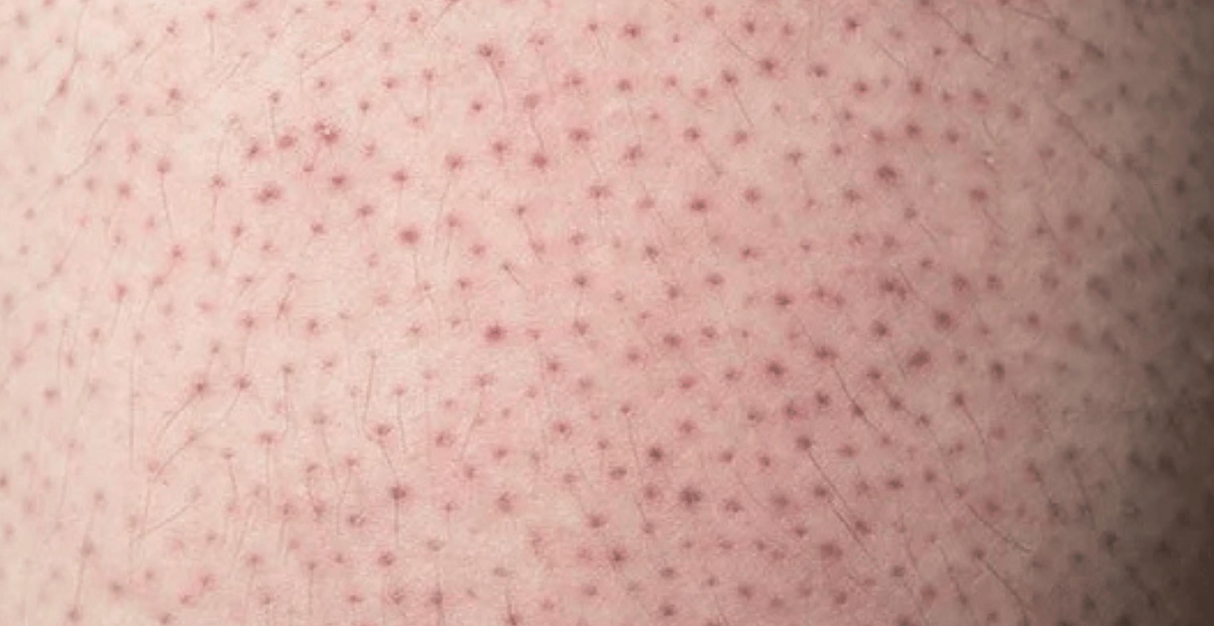 keratosis pilaris treatment