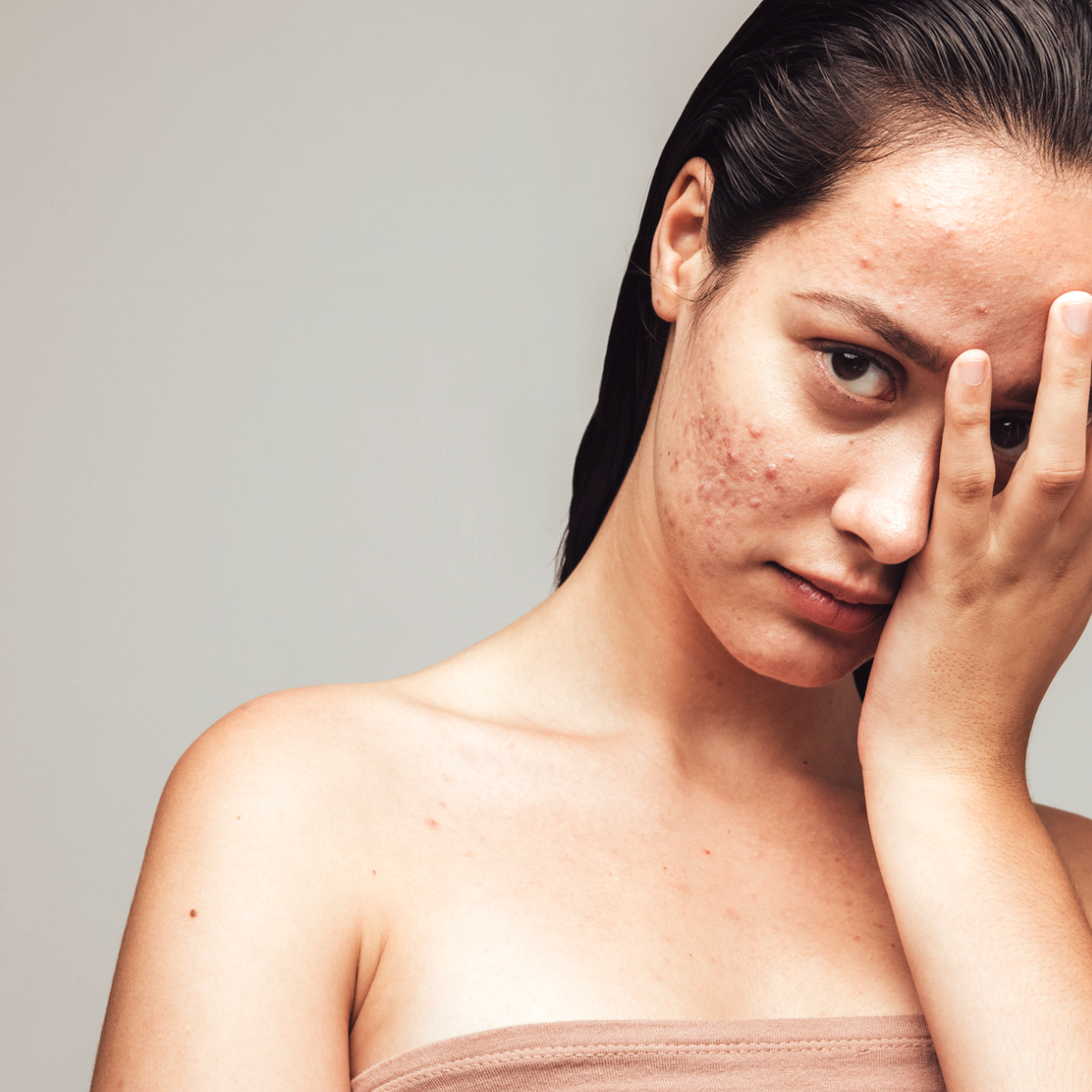 does klow help with acne CLA + L-carnitine for Fat Burning & Enhance Lean Muscle Mass