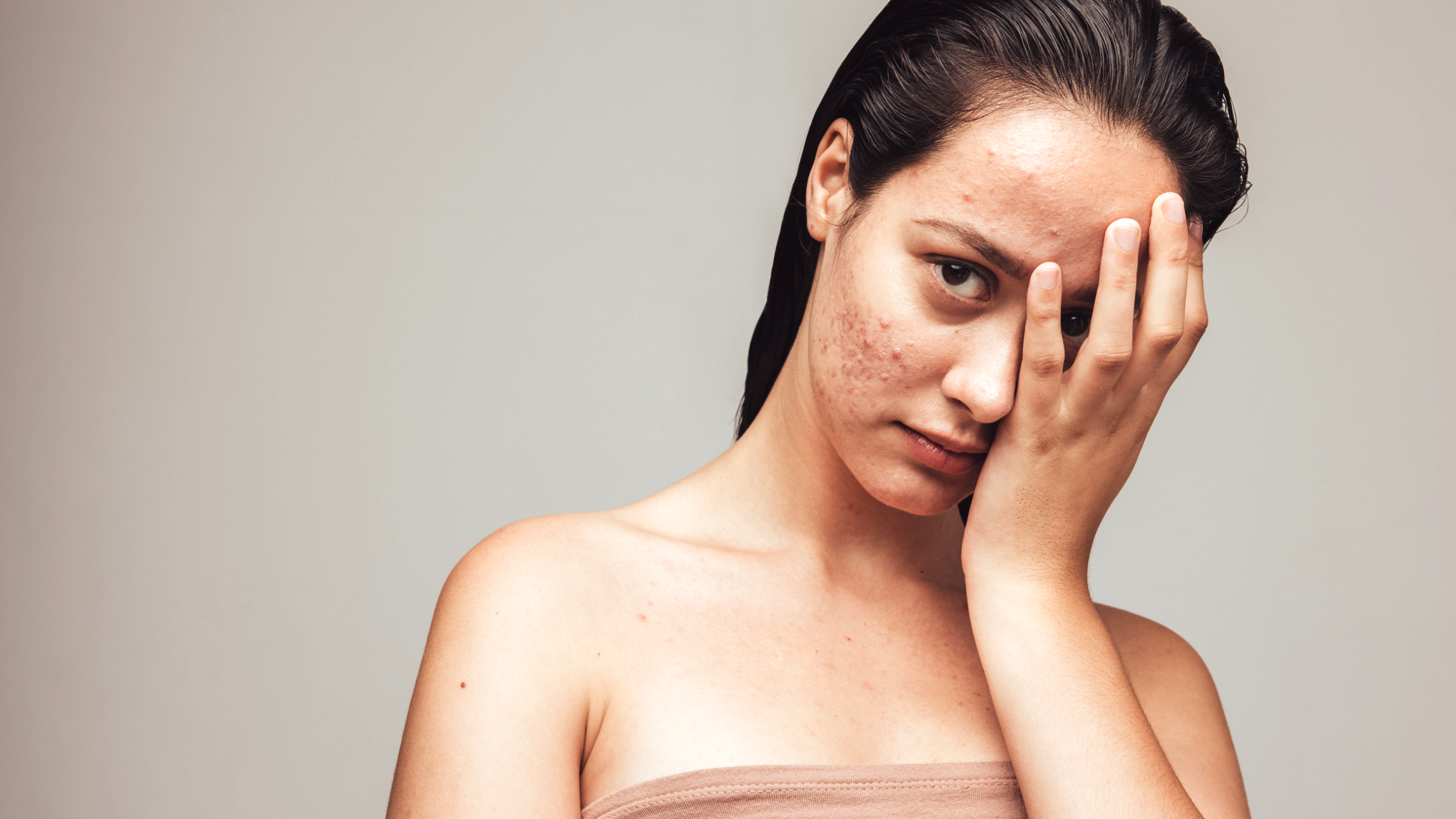 body acne treatments
