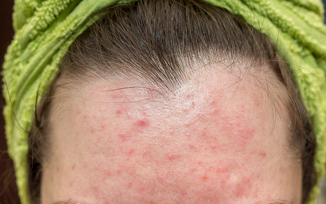 Flaky Facial Skin from Dandruff and Rosacea
