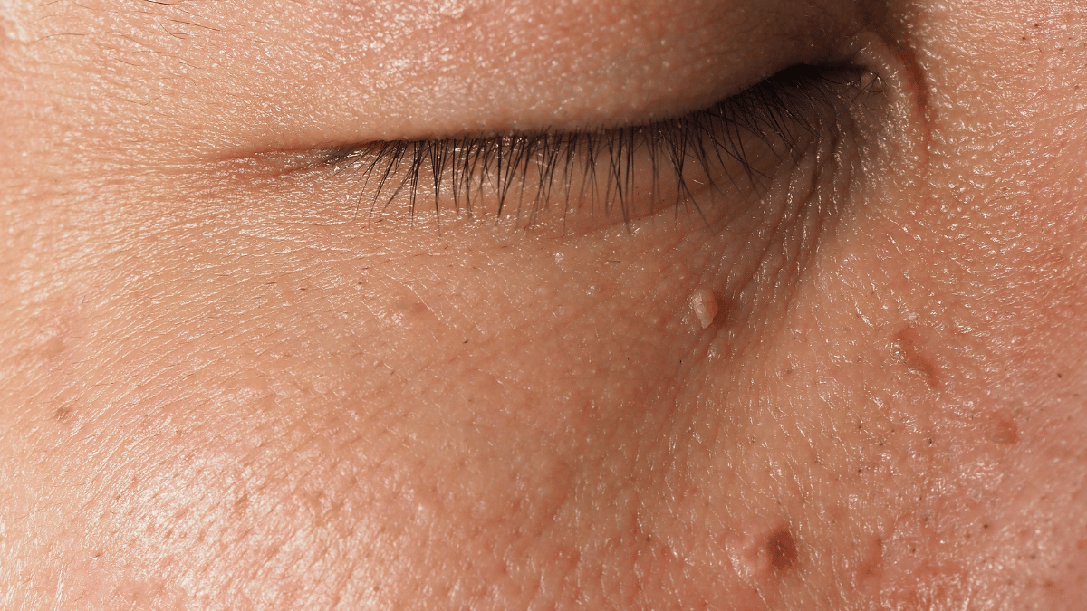 Wart Removal with Salicylic Acid