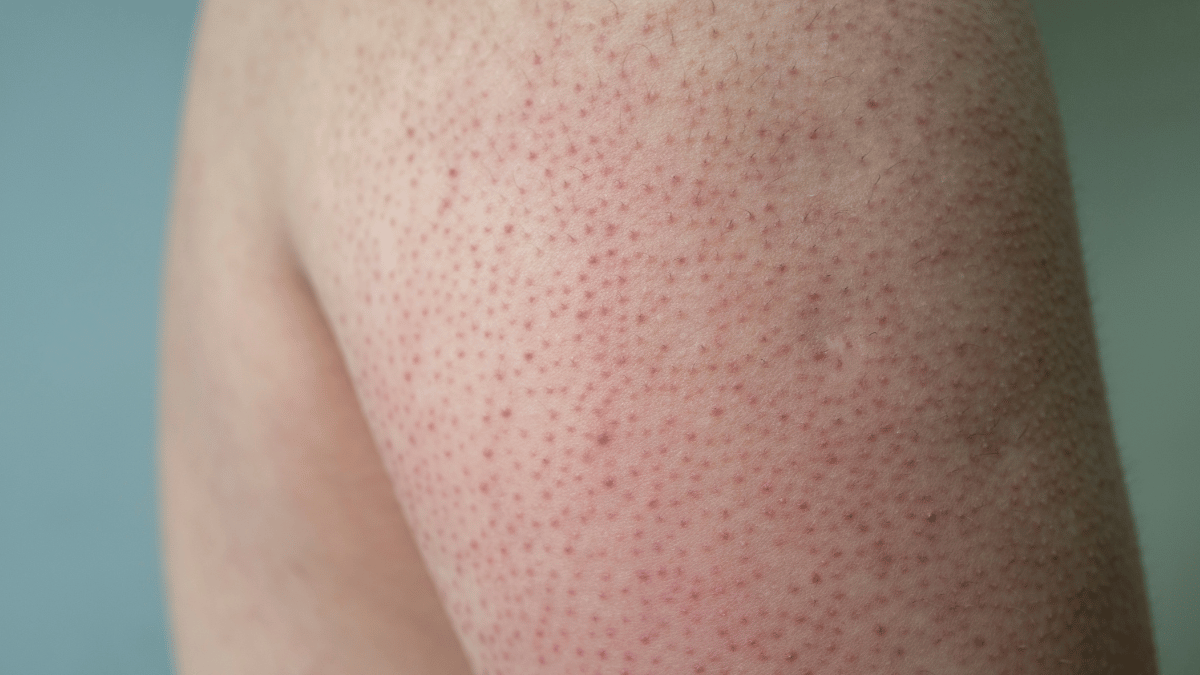 keratosis pilaris treatment