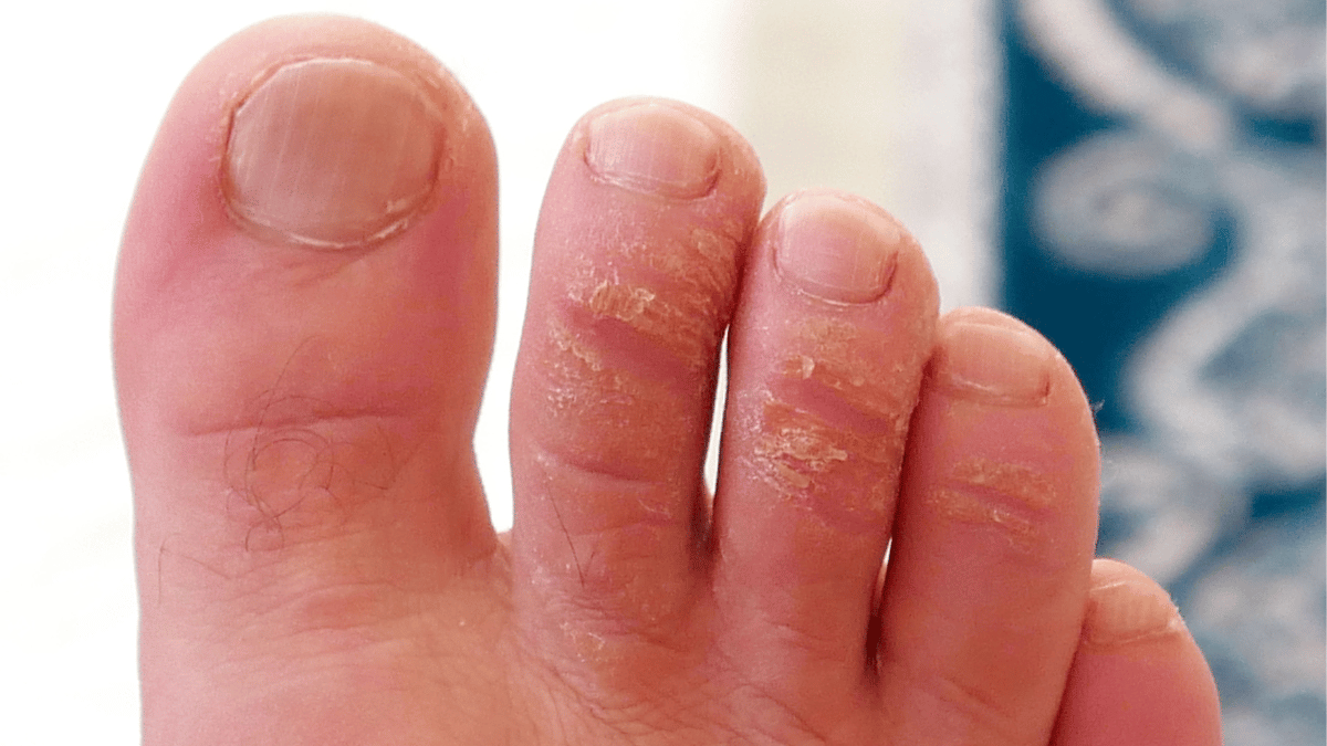 HOW TO PREVENT CORNS AND CALLUSES