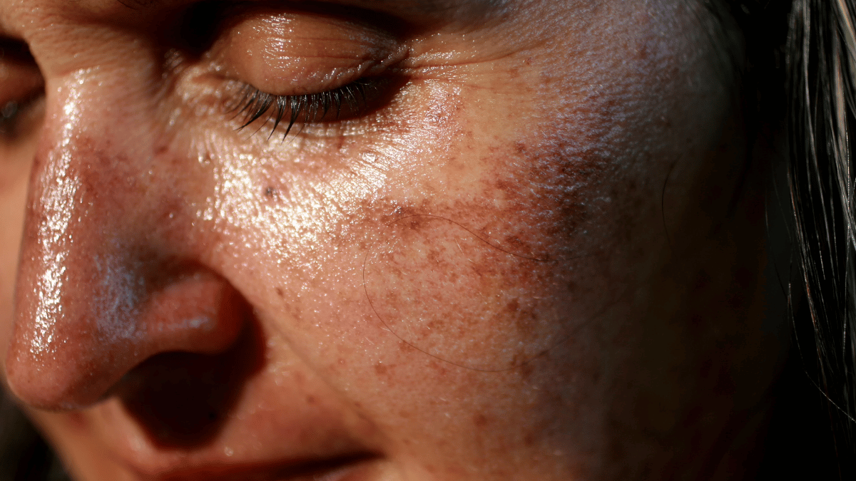 Can You Reverse Skin Aging From Sun Damage Clinikally can-you-reverse-skin-aging-from-sun-damage-clinikally