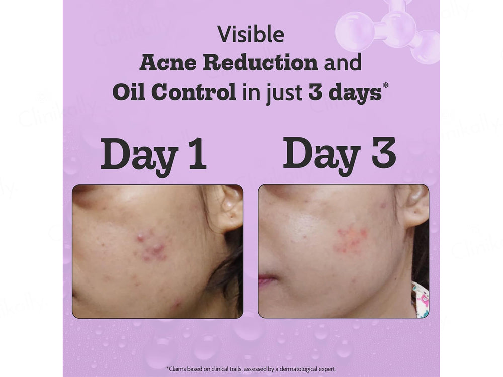 Chemist At Play 2% Salicylic Acid Acne Control Face Serum