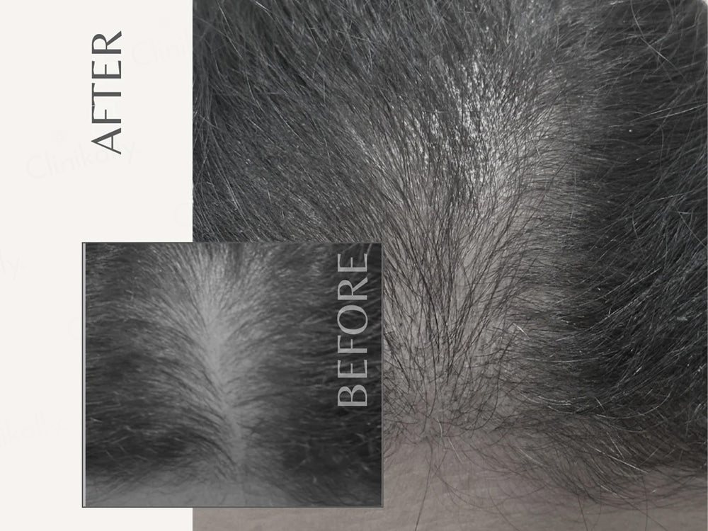 EnagenBio Nano Infuser Micro-Needling Serum Applicator Kit