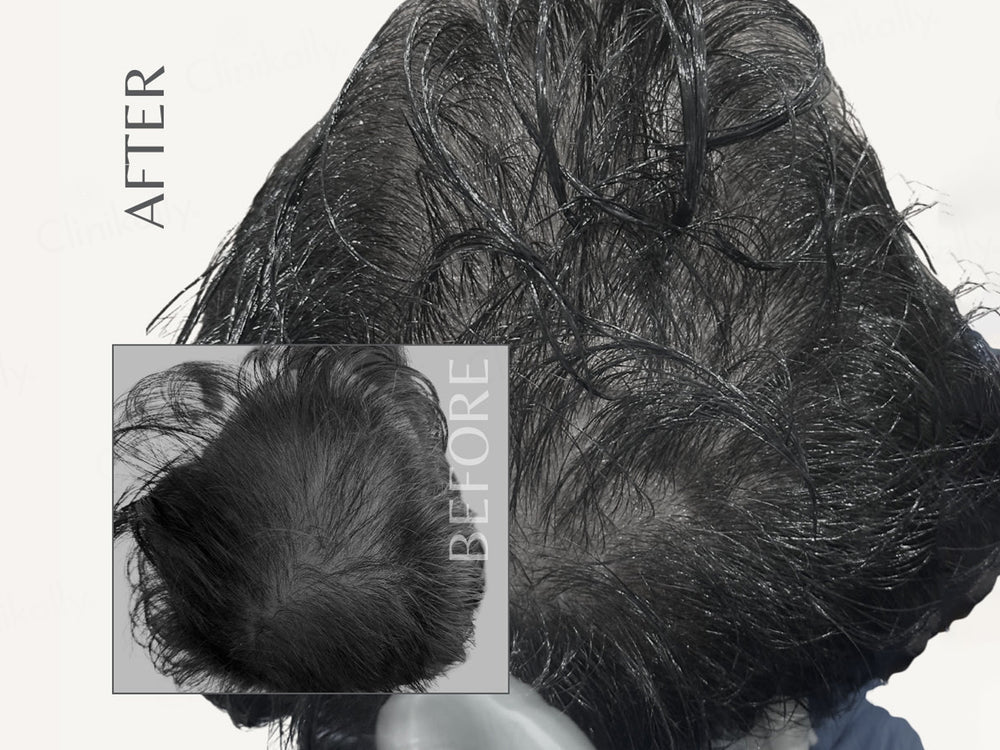 EnagenBio Nano Infuser Micro-Needling Serum Applicator Kit