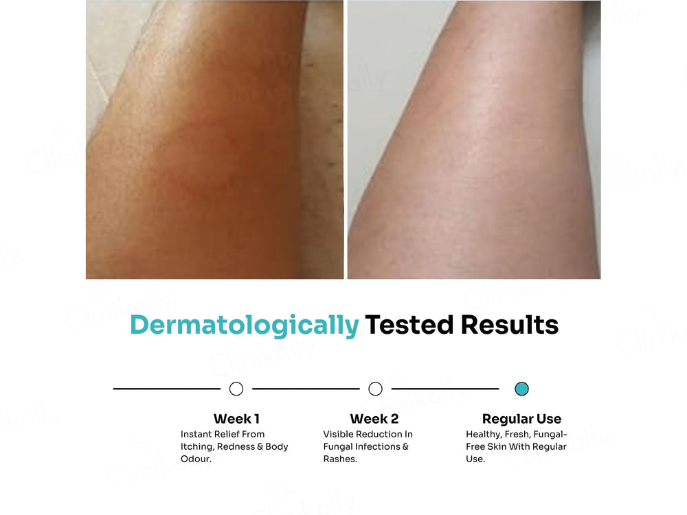 Kitcoz Anti Fungal Body Wash For Men & Women