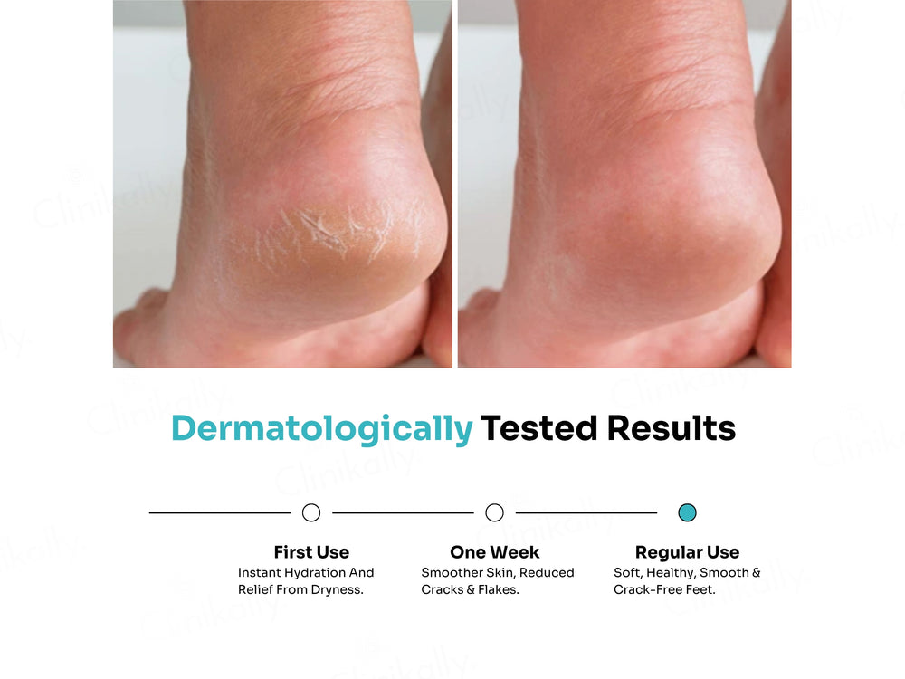 Kitcoz Foot Cream Roll-On For Cracked Heels & Diabetic Foot