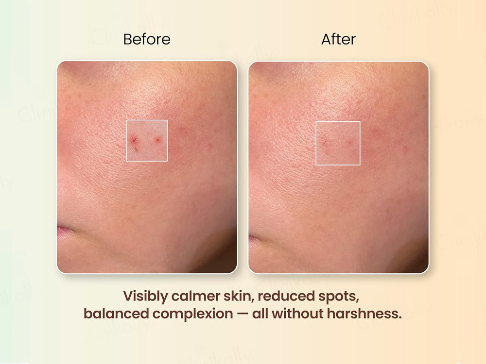 Moha: Spot Corrector Anti Acne Gel