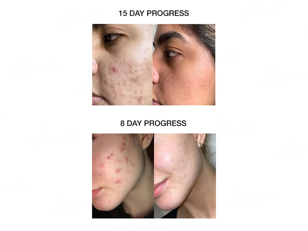 SKOG FAG Acne Clarifying Treatment Gel