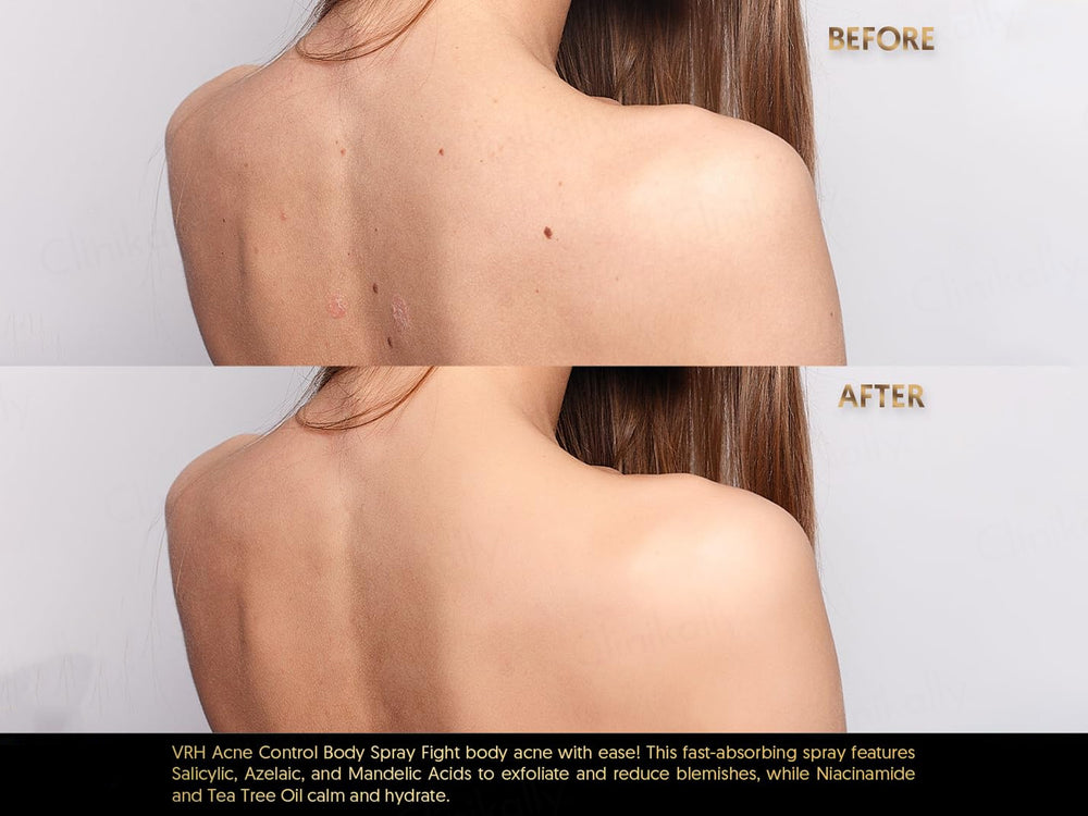 VRH Acne Clarify Therapy Body Spray