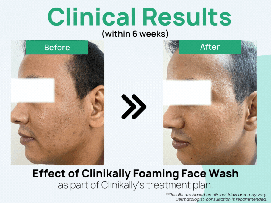 Clinikally Foaming Face Wash