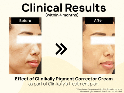 Clinikally Pigment Corrector Cream - Clinikally