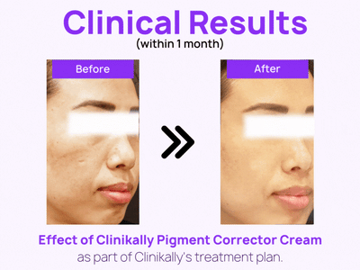 Clinikally The Ultimate NIA Serum + Pigment Corrector Cream