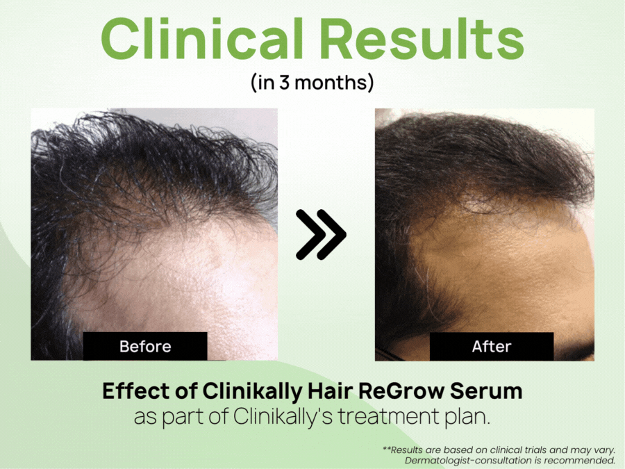 Clinikally Hair ReGrow Serum