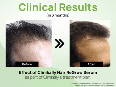 Clinikally Hair ReGrow Serum